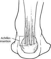 AchillesTendon