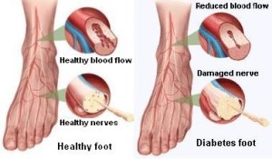 Diabetic Footcare