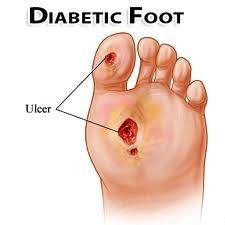 Diabetic Footcare