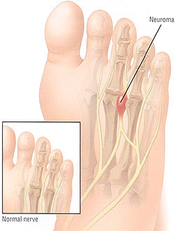 Morton’s Neuroma