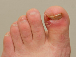 Ingrown Toenails