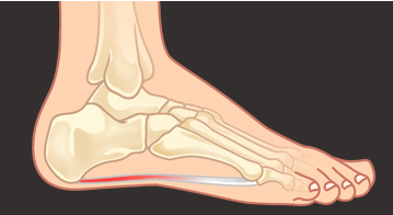 Big Toe Joint Arthritis