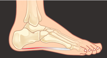 Big Toe Joint Arthritis