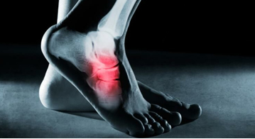 Plantar Fasciitis