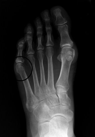 Tailor’s Bunion