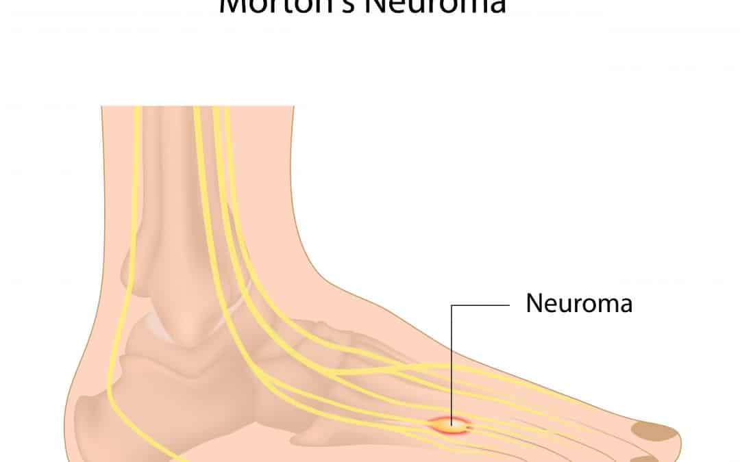What is Morton’s Neuroma Causes, Symptoms, and Treatment