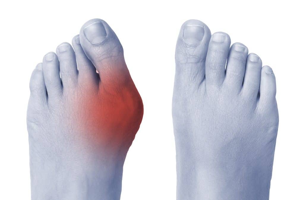 We Have the Solution to your Bunion Problems!