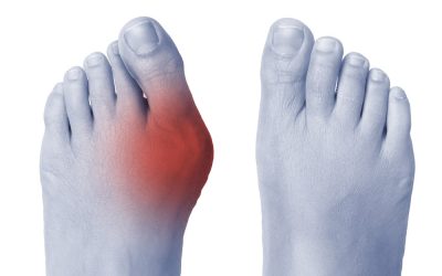 We Have the Solution to your Bunion Problems!