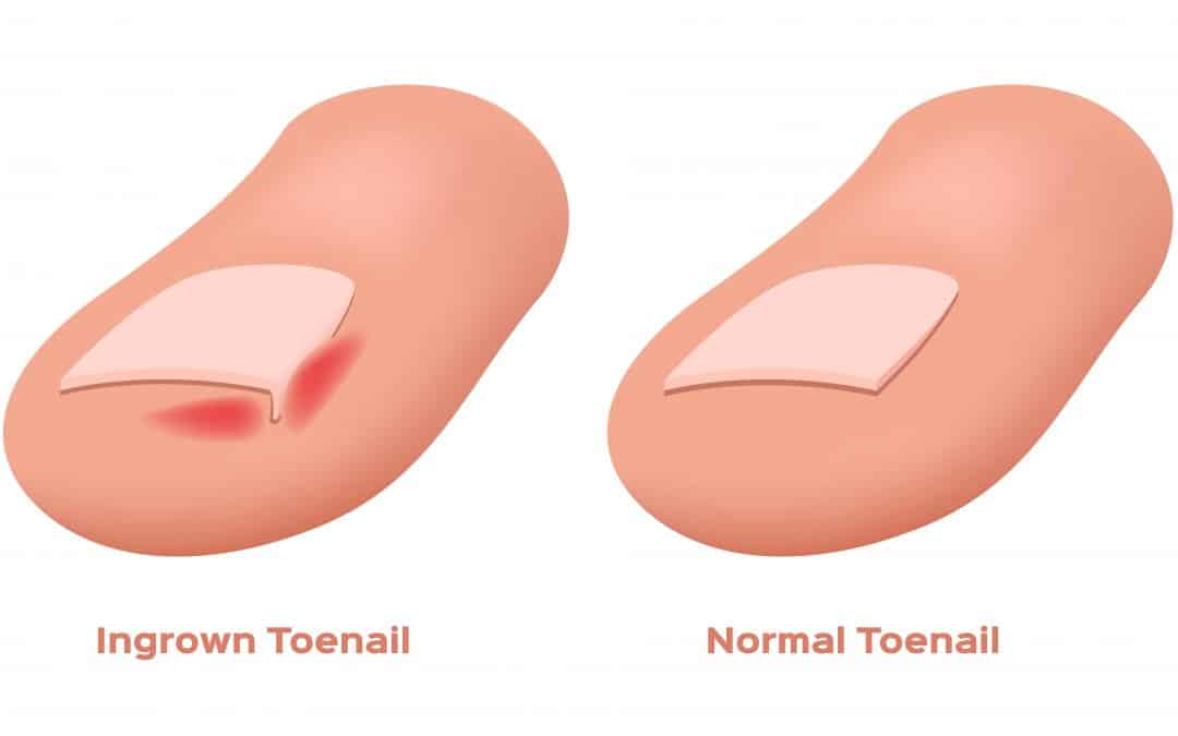 5 Tips on how to avoid Ingrown Toenails!