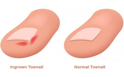 5 Tips on how to avoid Ingrown Toenails!