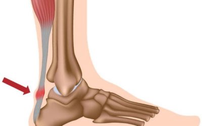 Achilles Tendinopathy & How To Fix It