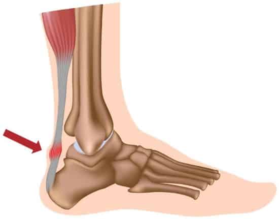 Achilles Tendinopathy & How To Fix It